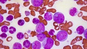 leukemia-kJUD-620x349@abc